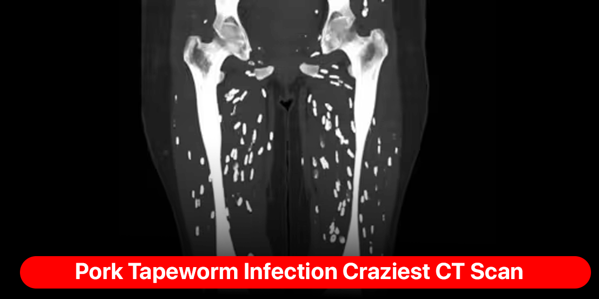 Pork Tapeworm Infection